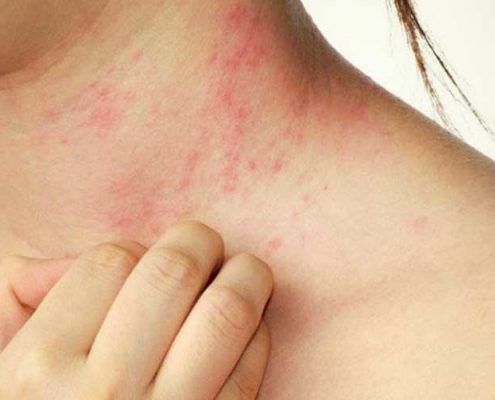 olio di oliva per la cura della psoriasi