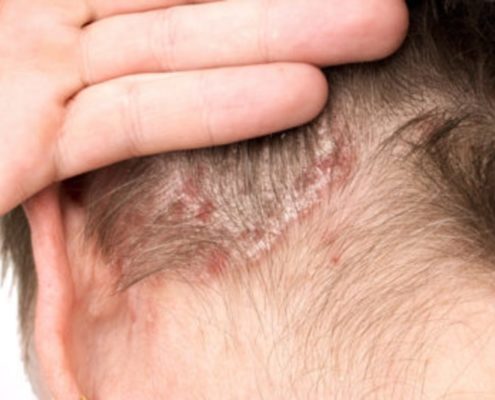 Olio di Oliva, utile rimedio alla Dermatite Seborroica