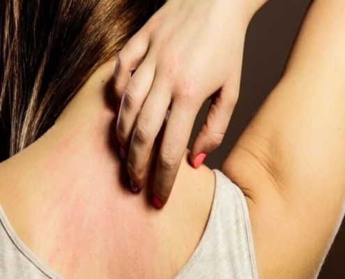 Olio evo un buon rimedio contro l’Orticaria