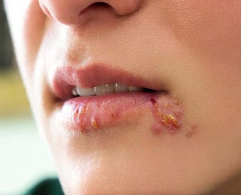 L'Olio Evo: rimedio efficace contro l'Herpes Labiale
